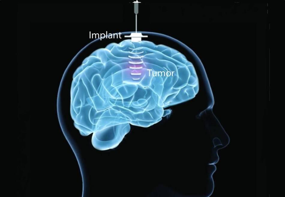 Carthera lève 42 millions d'euros pour accélérer le développement de son dispositif médical révolutionnaire
