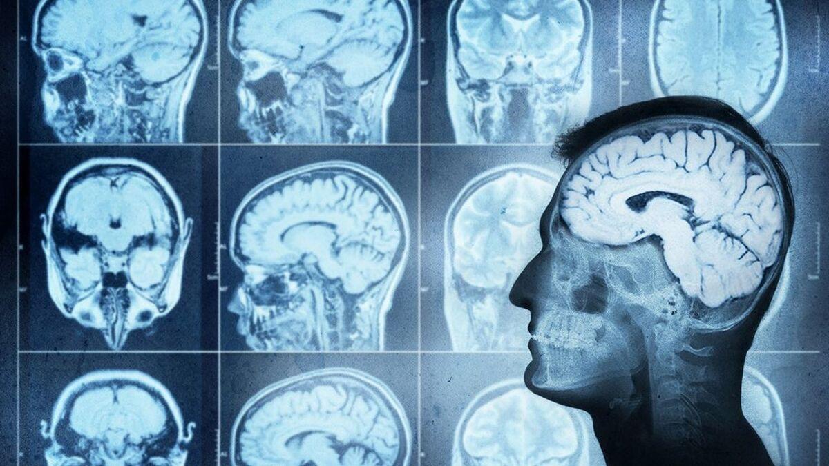 RebrAIn lève 3,7 millions d’euros pour transformer la neurochirurgie